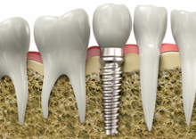 Dental Implants - Save Your Smile!
