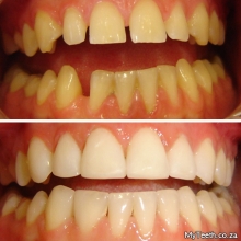 BEFORE:  Gap and uneven front teeth.  AFTER:  Dental Veneers re-shaped 4 front teeth in just 1 visit.