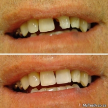 BEFORE:  Broken front tooth.  AFTER:  Tooth repaired in 1 visit by using composite bonding. NO injections needed.