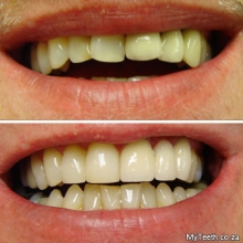BEFORE: Crooked and stained teeth.  AFTER:  New Dental Bridge top left and Dental Veneers on front teeth.