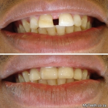 BEFORE:  Big gap between front teeth.  AFTER:  4 Front teeth were treated with White Composite Bonding in 1 visit.