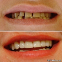 BEFORE:  Gaps between front teeth and yellow stained teeth.  AFTER:  Teeth Whitening & Composite Bonding were used to create the new look in 1 visit.